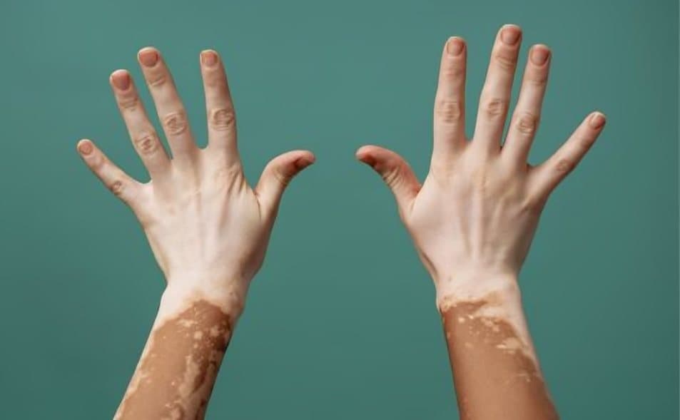 Vitiligo Belirtileri ve Tedavileri | Doktorify